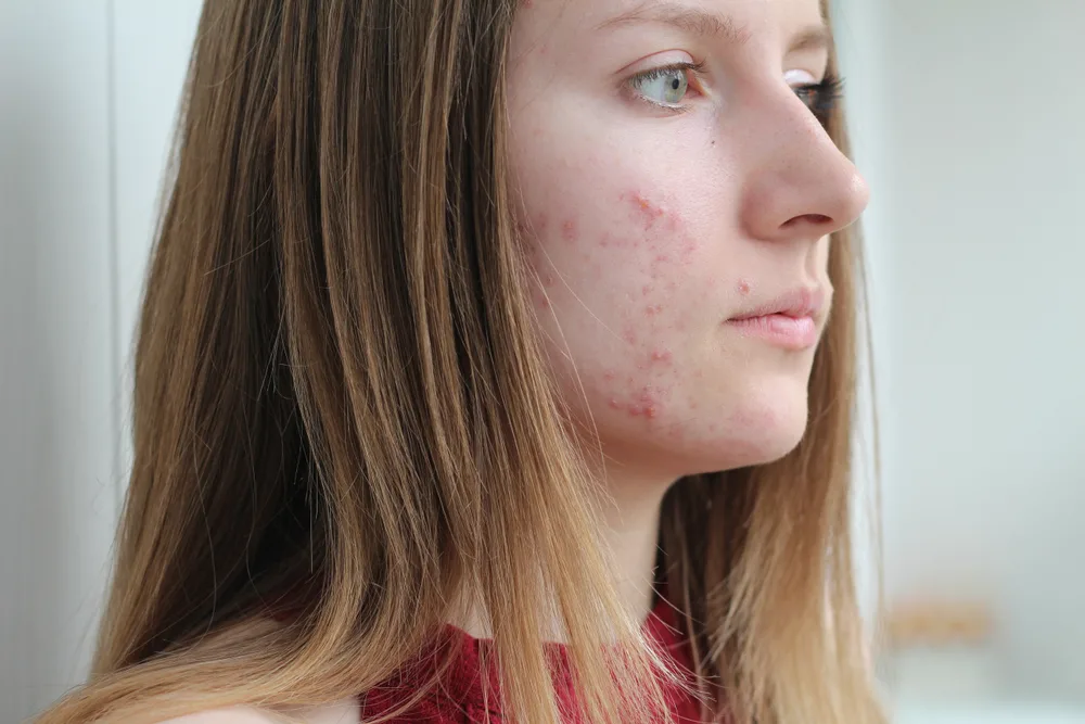 A young woman with typical acne.