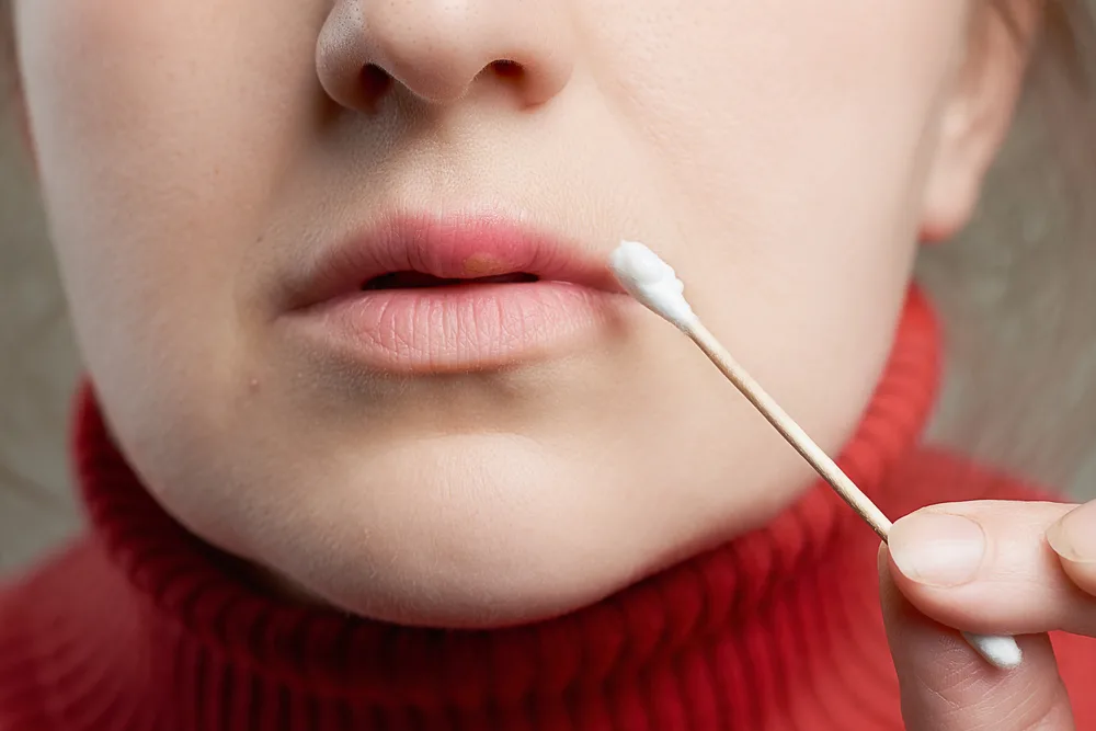 A woman with a cold sore dabs the sore with a cotton swab.
