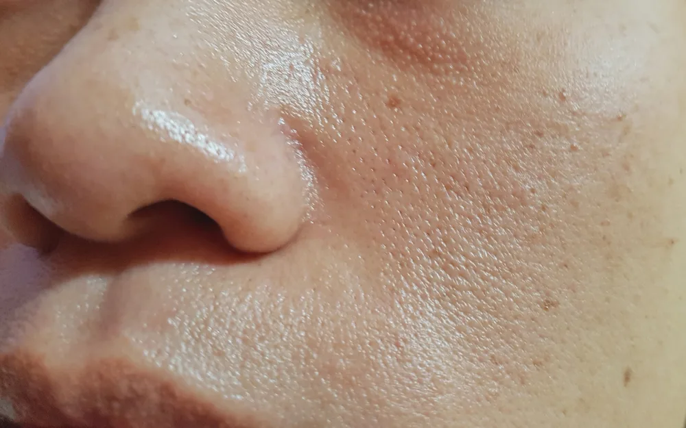 A close up of a man's oily skin.