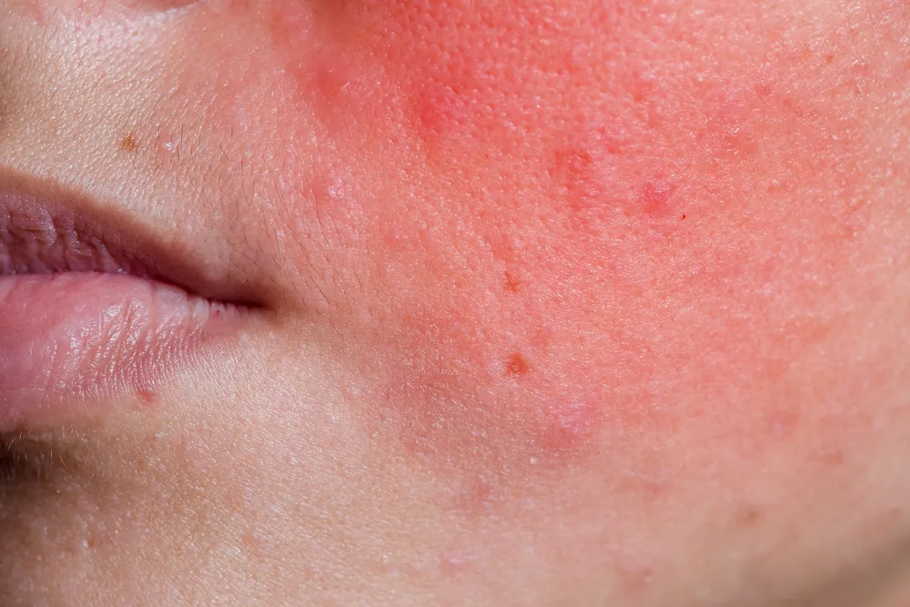 Close up of a woman's face with an adverse reaction to cosmetics. Skin is red and inflammed.
