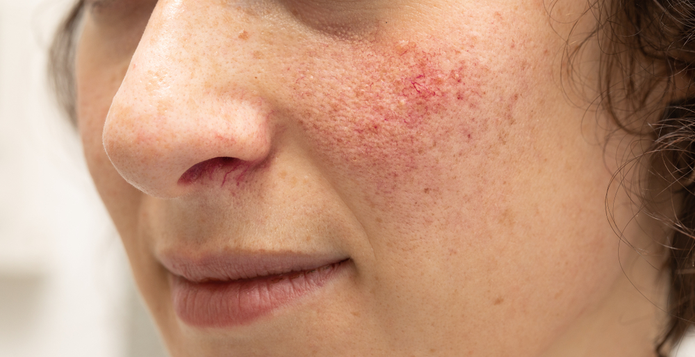 A close up of a woman's face, she has mild rosacea on her cheeks.
