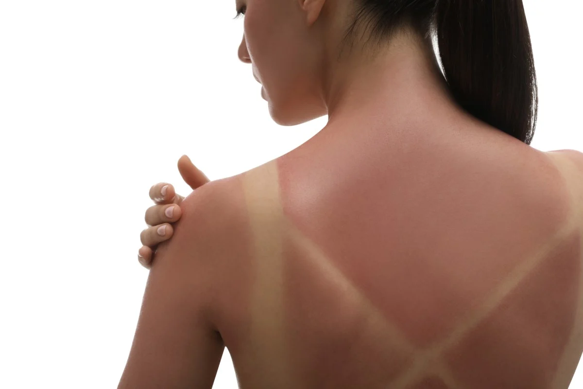 A woman's shoulders are sunburned, you can see the lines from her top.